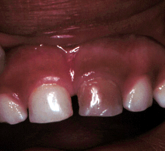 Will loose teeth tighten up?